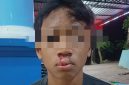 Korban penganiayaan mengalami luka cukup serius dibagian bibir.