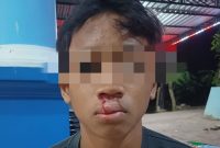 Korban penganiayaan mengalami luka cukup serius dibagian bibir.