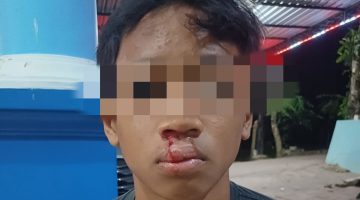 Korban penganiayaan mengalami luka cukup serius dibagian bibir.