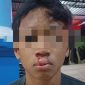 Korban penganiayaan mengalami luka cukup serius dibagian bibir.